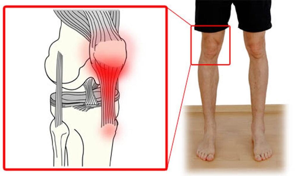 Tendinit – diz eklemindeki tendonların iltihabı