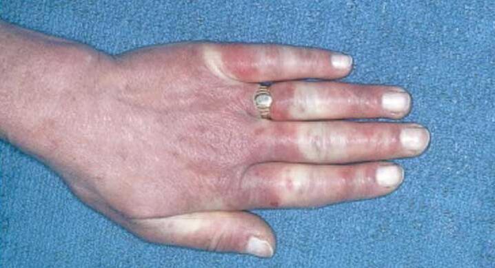 Raynaud sendromunun klinik tablosu - vazospazm, hiperemi, ödem